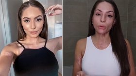 Odvážná Týnuš Třešničková: Popálená youtuberka odhalila vše bez závanu make-upu! A jizvy?