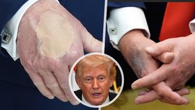 Chorý a tajnůstkářský Trump: Snažil se tajit modřiny, až pak přiznal diagnózu