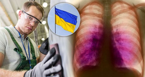 Cizinců s tuberkulózou přibývá: Do Česka ji přináší hlavně pracovníci z Ukrajiny