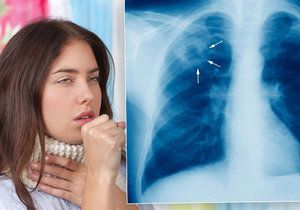 Tuberkulóza je smrtelná nemoc.