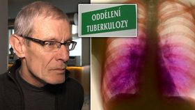 Vladimír (63) strávil dva měsíce v izolaci kvůli tuberkulóze. Lékaři: Česko je rarita
