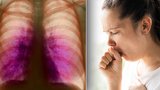 V Česku přibylo pacientů s odolnou tuberkulózou: Příznaky jsou nejasné, varuje pneumolog
