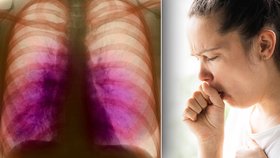 Lea (22) se nakazila tuberkulózou: Léčbu komplikuje nemocným pandemie