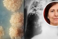 Migrační vlna z Ukrajiny může v Česku »zamávat« s tuberkulózou, varují plicní lékaři. Jaké jsou příznaky nemoci?