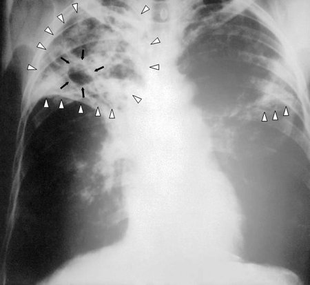 Tak vypadá tubera na rentgenovém snímku.