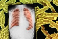 Tuberkolóza mezi uprchlíky? Čeští lékaři radí klid, našli ji jen u dvou lidí