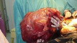 Nejtěžší tumor světa vážil dvacet tři kilogramů!