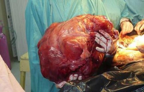 Nejtěžší tumor světa vážil dvacet tři kilogramů!