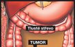 Tumor: Původně označení pro jakýkoliv otok tkáně. Lékaři dnes tento pojem používají většinou jen v souvislosti s rakovinou.