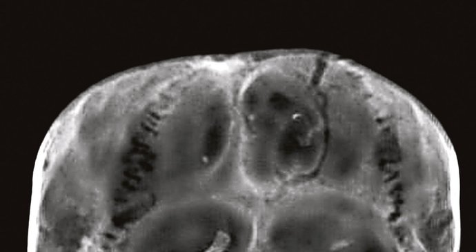 První radiologické vyšetření lebky z 50. let minulého století prokázalo, že v ní byl otvor.