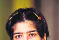Indická holčička místo slz pláče krev