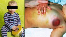 Teprve rok a půl starého chlapečka týrali rodiče: Měl popálené nohy a obličej samou modřinu (ilustrační foto)