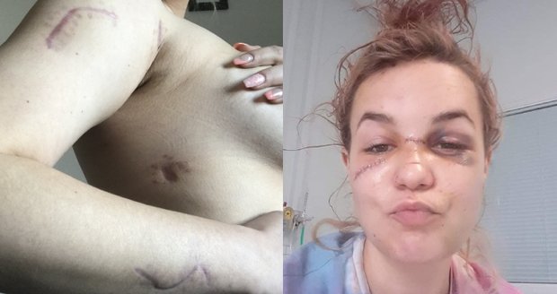 Láska skončila 11 bodnými ranami! Češka Cynthie (23) popsala brutální útok expřítele a ukázala rány