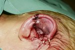 Po operaci: Lékaři ucho přišili. Hoch musel podstoupit dvě operace