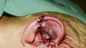 Po operaci: Lékaři ucho přišili. Hoch musel podstoupit dvě operace