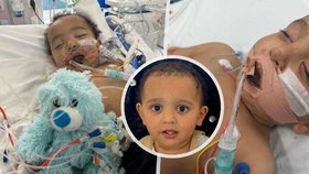 Malý Samík utrpěl popáleniny a srdeční zástavu po vypití louhu.