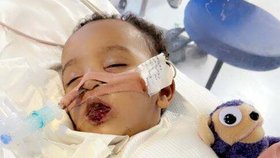 Malý Samík utrpěl popáleniny a srdeční zástavu po vypití louhu.