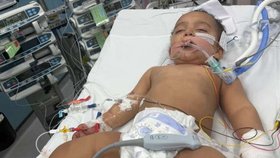 Malý Samík utrpěl popáleniny a srdeční zástavu po vypití louhu.