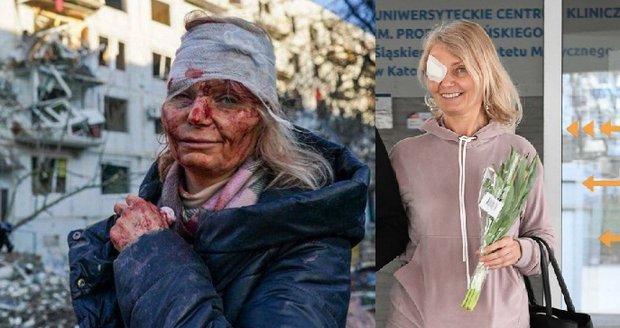 Olena se stala tváří války na Ukrajině: Operace jí zachránila zrak, vrátila se k učení