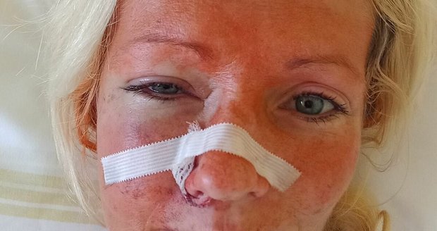 Ukrajinka Lilia skončila po napadení v nemocnici se zlomeninami v obličeji.