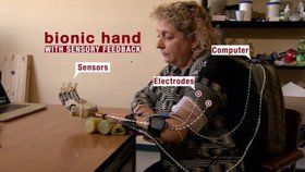 První žena vyzkoušela bionickou ruku s hmatovými vjemy.