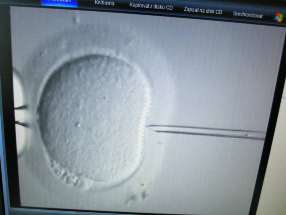 Umělé oplodnění: Odběr vajíček se provádí pod ultrazvukovou kontrolou.