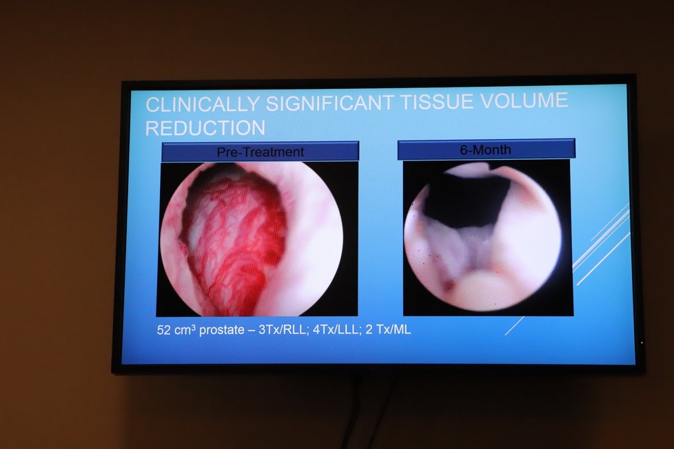 Prostata před a po zákroku.
