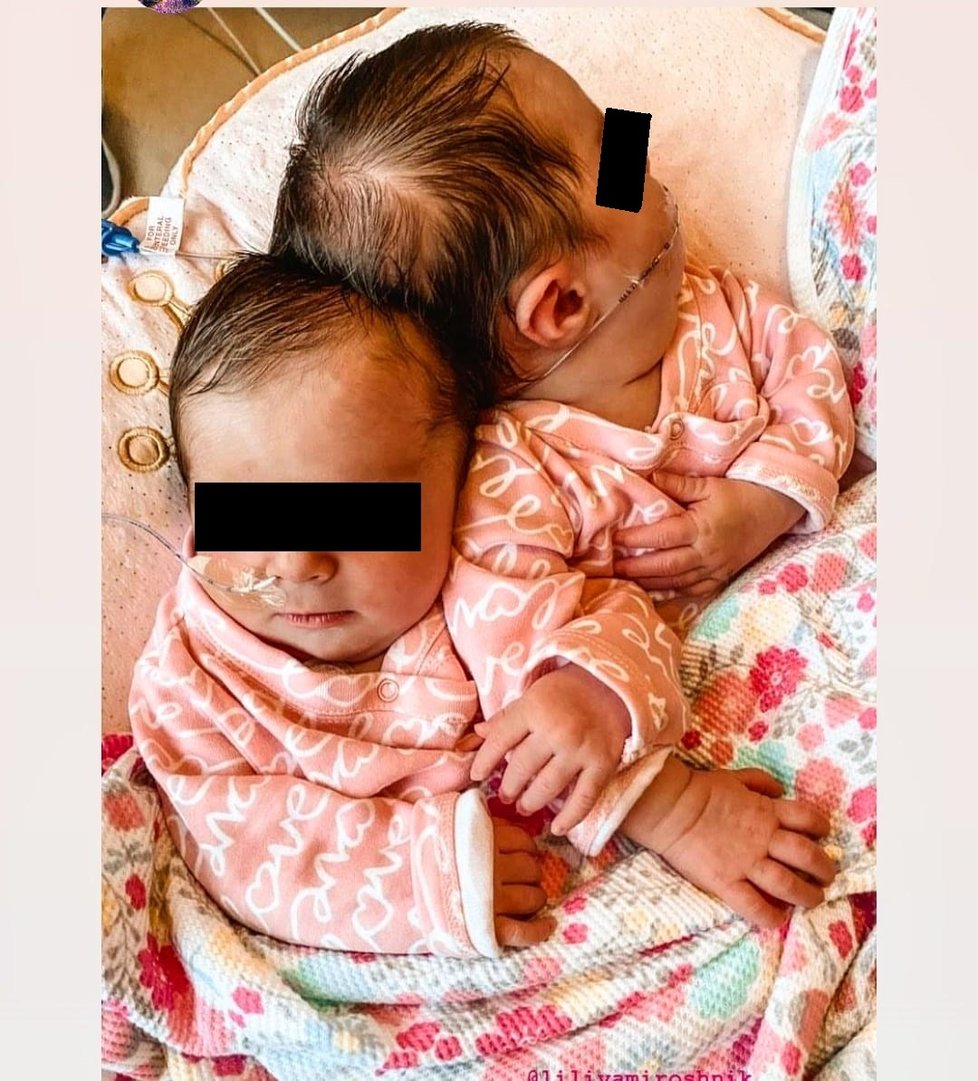 Siamská dvojčata byla k sobě srostlá hlavami: Lékaři je 24hodinové operaci dokázali oddělit!