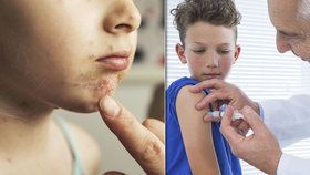 Americkou školu zachvátila epidemie planých neštovic, rodiče nechtějí očkovat své děti