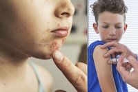 Rodiče odmítali očkování. Školu zachvátila největší epidemie neštovic za desítky let