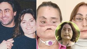 Zemřela první žena, které transplantovali tvář. Manžel ji střelil brokovnicí do obličeje