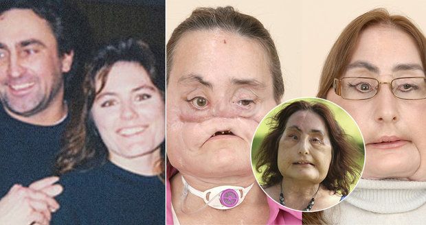 Zemřela první žena, které transplantovali tvář. Manžel ji střelil brokovnicí do obličeje