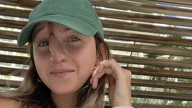 Nový nos jí lékaři vytvořili z kůže na čele.