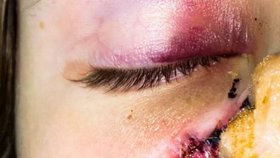 Nový nos jí lékaři vytvořili z kůže na čele.