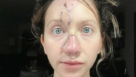 Nový nos jí lékaři vytvořili z kůže na čele.