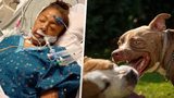Nepříčetný pitbull roztrhal cyklistku: Museli jí amputovat všechny končetiny!