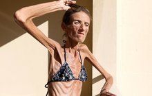 ŠOKUJÍCÍ FOTO Nejhubenější žena světa: Anorexie z ní udělala chodící kostru!