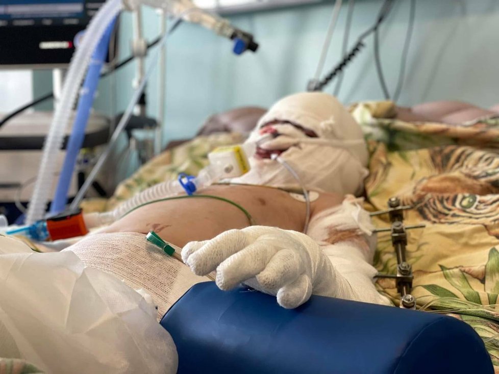 Malý Ukrajinec utrpěl těžké popáleniny, má zlomenou ruku a v hlavě šrapnely.
