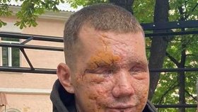 Vladyslav po výbuchu miny oslepl.