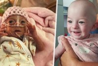 Miminko do dlaně: Vaneska je nejmenším dítětem v olomoucké nemocnici, po narození vážila jen 395 gramů