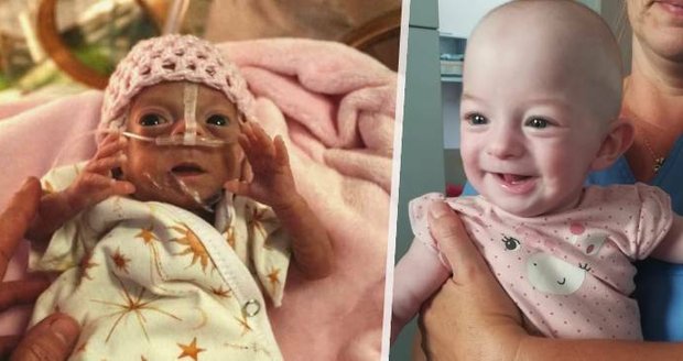 Miminko do dlaně: Vaneska je nejmenším dítětem v olomoucké nemocnici, po narození vážila jen 395 gramů
