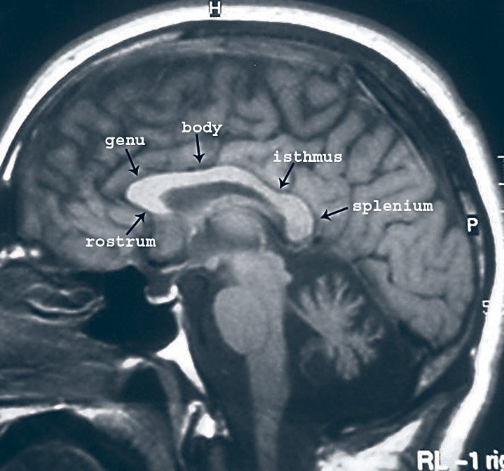 Normální mozek. Obě hemisféry jsou normálně spojeny miliony nervových buněk