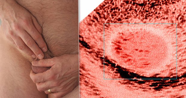 Rakovina varlat může postihnout i patnáctileté hochy, nejohroženější ale jsou muži od 25-35 let