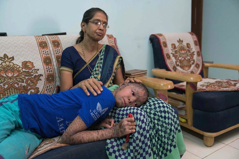V Indii útočí smrtelný virus nipah, zabil již 13 lidí