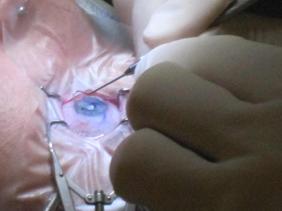 Grafička magazínu Blesk zdraví Veronika podstoupila laserovou operaci očí.
