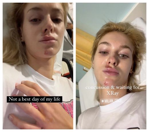 Slovenská modelka Veronika Rajeková (27) bourala na skútru a skončila v nemocnici s otřesem mozku a s četnými šrámy na obličeji. Slovenská modelka Veronika Rajeková (27) bourala na skútru a skončila v nemocnici s otřesem mozku a s četnými šrámy na obličeji.