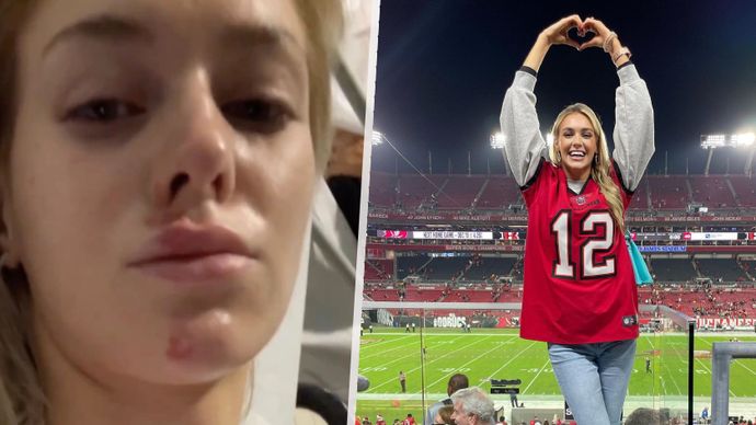 Slovenská modelka Veronika Rajeková (27) bourala na skútru a skončila v nemocnici s otřesem mozku a s četnými šrámy na obličeji.
