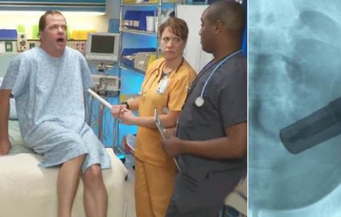 Muže trápila krutá zácpa: Lékaři rentgenem zjistili, že mu manželka narvala do zadku vibrátor!