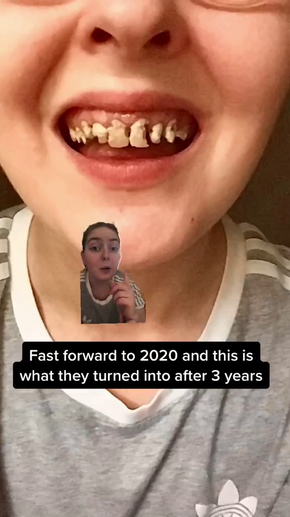 Victoria Nowakowskiová na videu zmapovala, jak jí shnily zuby kvůli pití limonády. Žena poté podstoupila jejich vytrhání a pořídila si zubní náhradu.