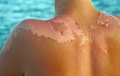 Hrozí vám rakovina kůže? Pokud jste se v pubertě spálili, je riziko dvojnásobné!